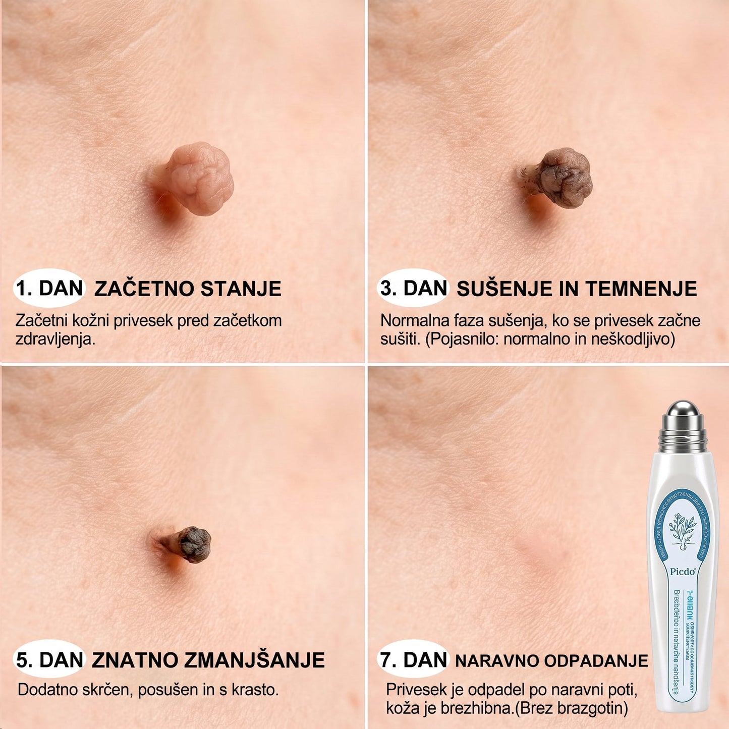 𝐏𝐢𝐜𝐝𝐨® 7-dnevno pisalo za odstranjevanje pigmentnih madežev in brazgotin (neboleče, brez brazgotin – z valjčnim aplikatorjem) 🎇