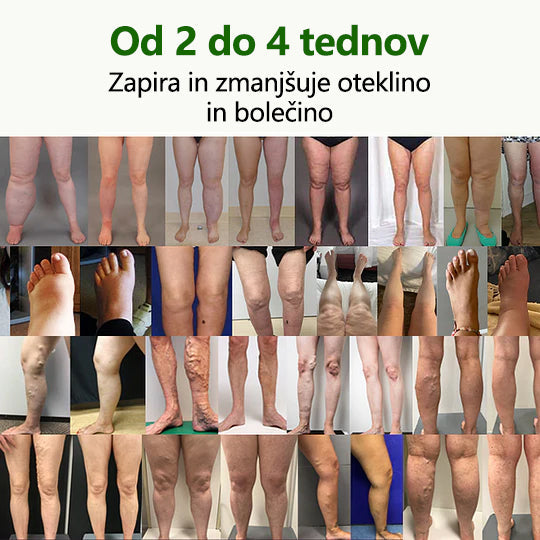 ✨ Poslovite se od otečenih, bolečih nog – CleraNaure® FluidEase Profesionalna krema za izboljšanje prekrvavitve nog prinaša pravo olajšanje! ✨🦵