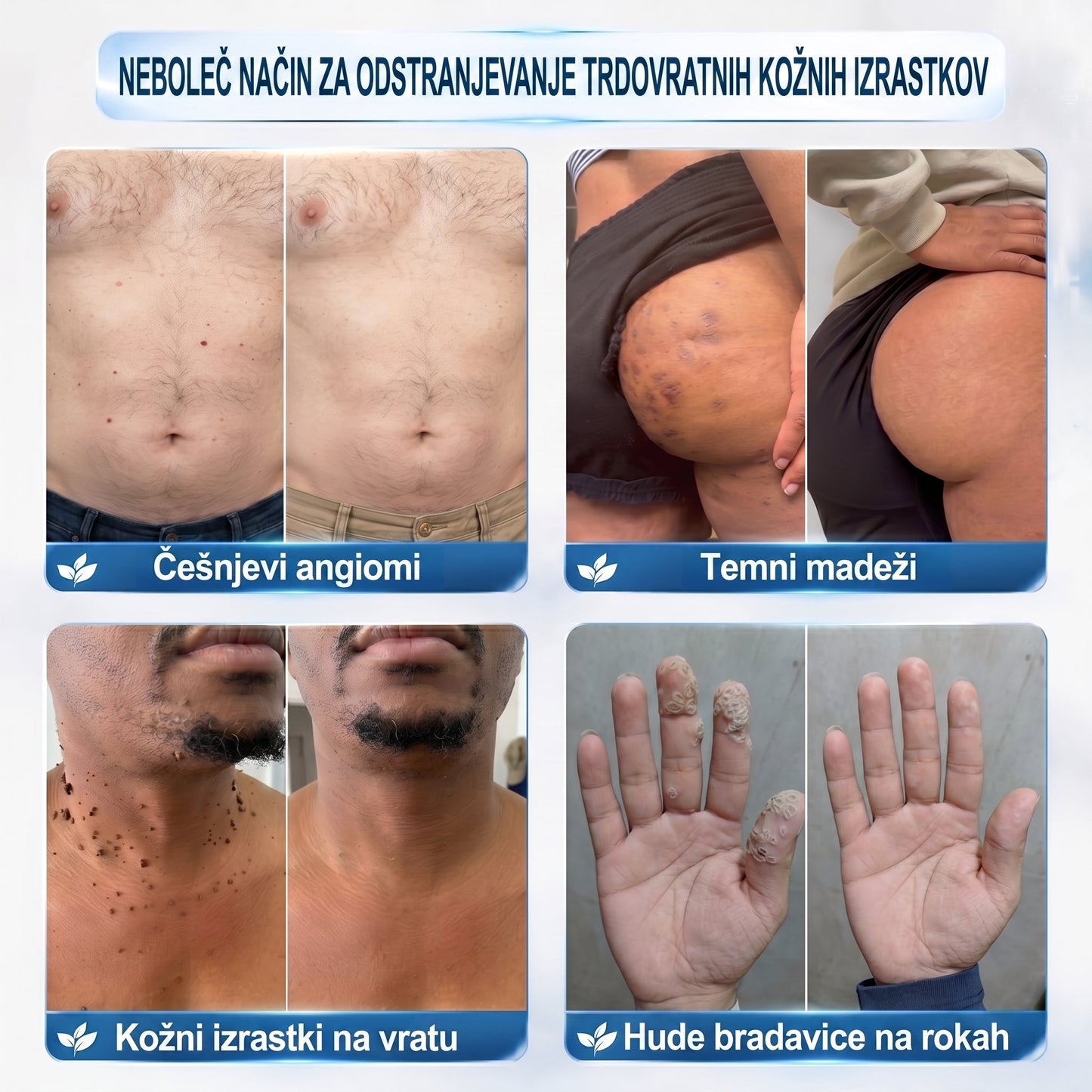 𝐏𝐢𝐜𝐝𝐨® 7-dnevno pisalo za odstranjevanje pigmentnih madežev in brazgotin (neboleče, brez brazgotin – z valjčnim aplikatorjem) 🎇