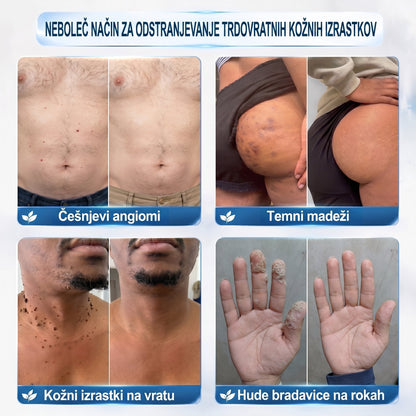 𝐏𝐢𝐜𝐝𝐨® 7-dnevno pisalo za odstranjevanje pigmentnih madežev in brazgotin (neboleče, brez brazgotin – z valjčnim aplikatorjem) 🎇